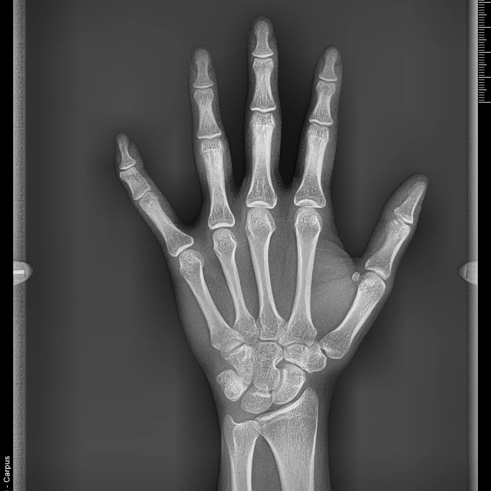 Radiografia-Carpal-scaled