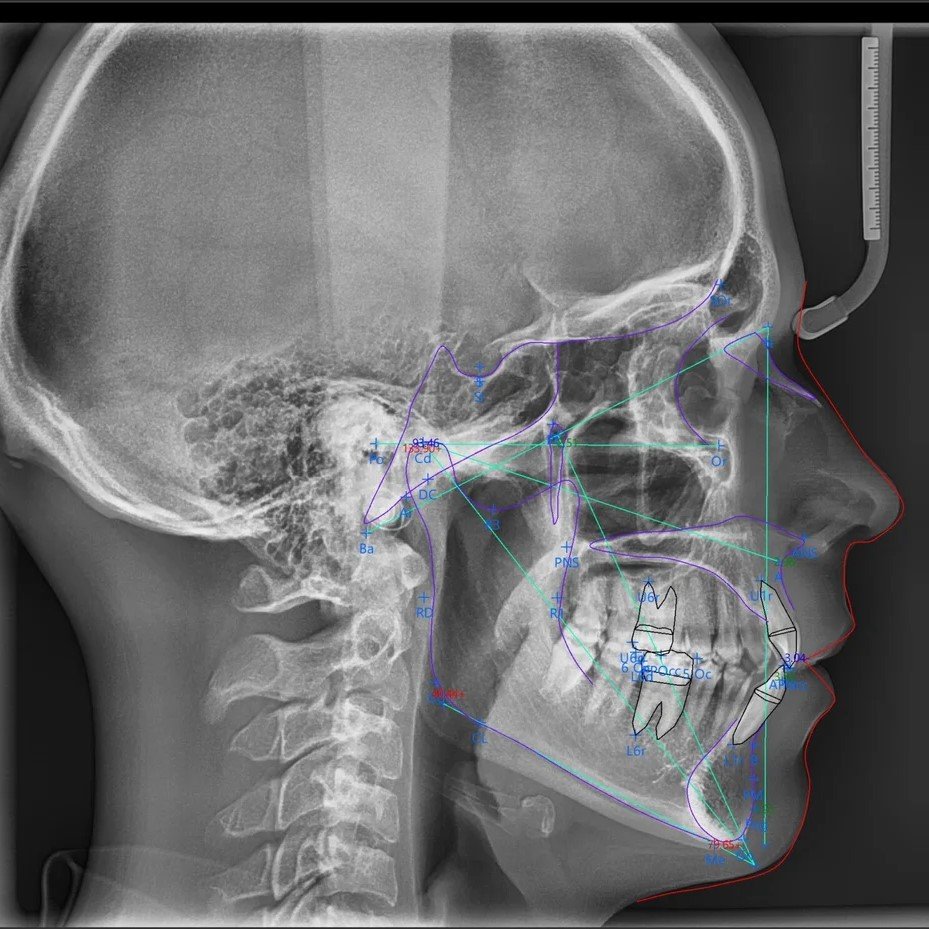 Radiografia-Lateral-con-trazados-cefalometrico-scaled